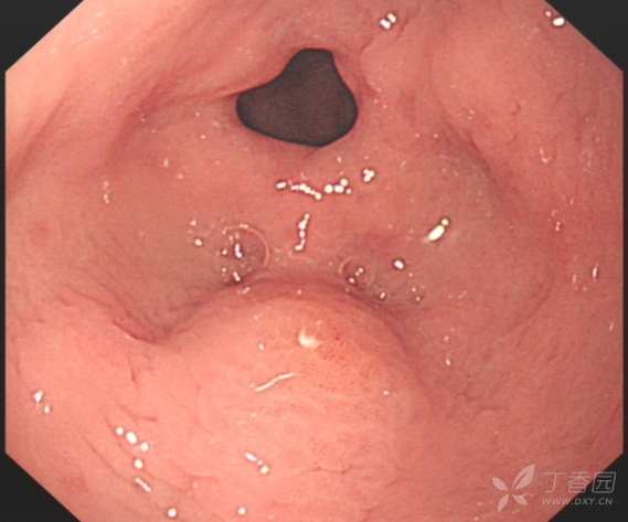 胃窦胃镜图片图片