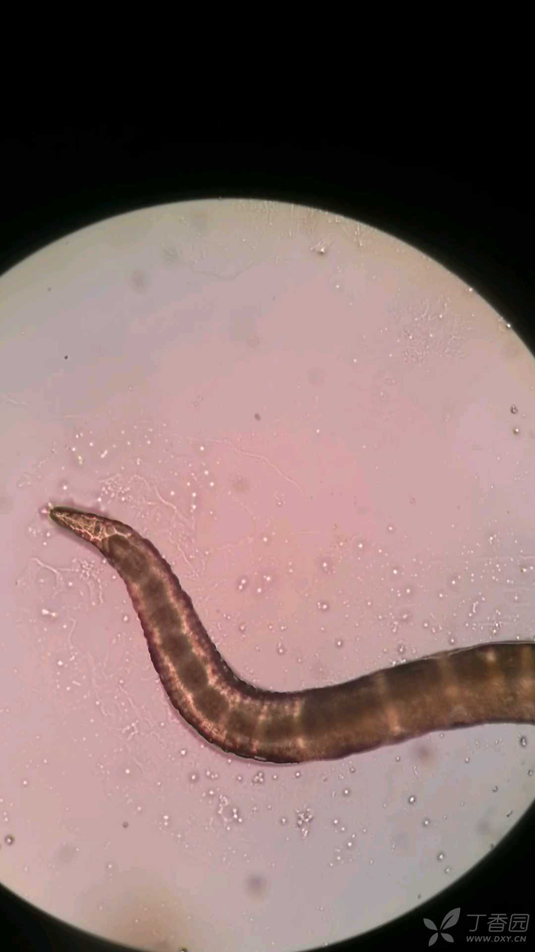食管粘膜下的虫子