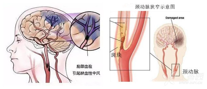 颈动脉斑块如何评估?