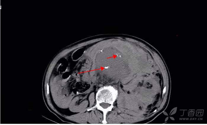 腹腔出血ct图片图片