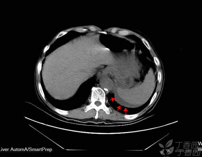 致命性腹痛之腹主动脉瘤破裂出血