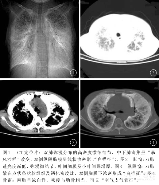 矽结节图片