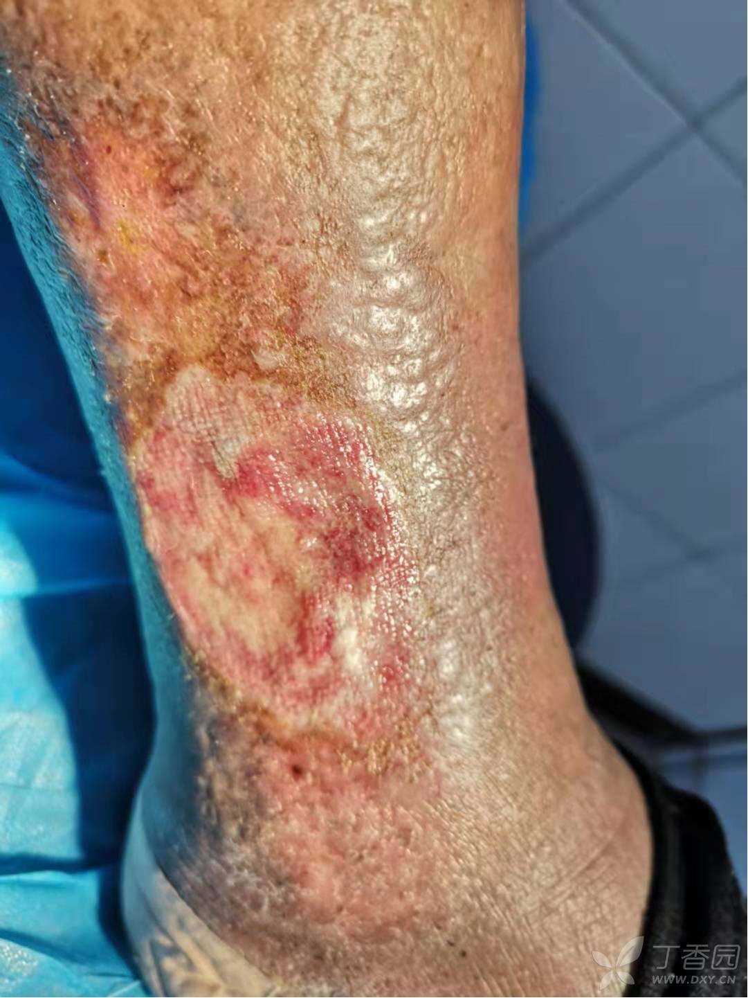 慢性疮疡的请教