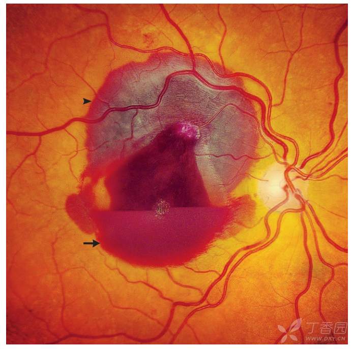 钝性眼外伤致视网膜出血【nejm】
