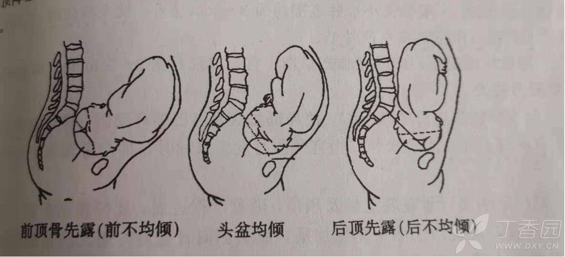 胎儿右枕横位图片图片