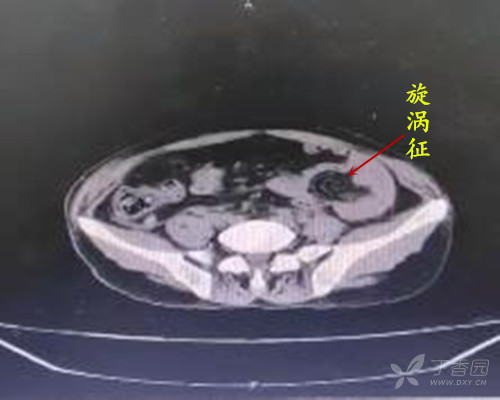 考慮乙狀結腸扭