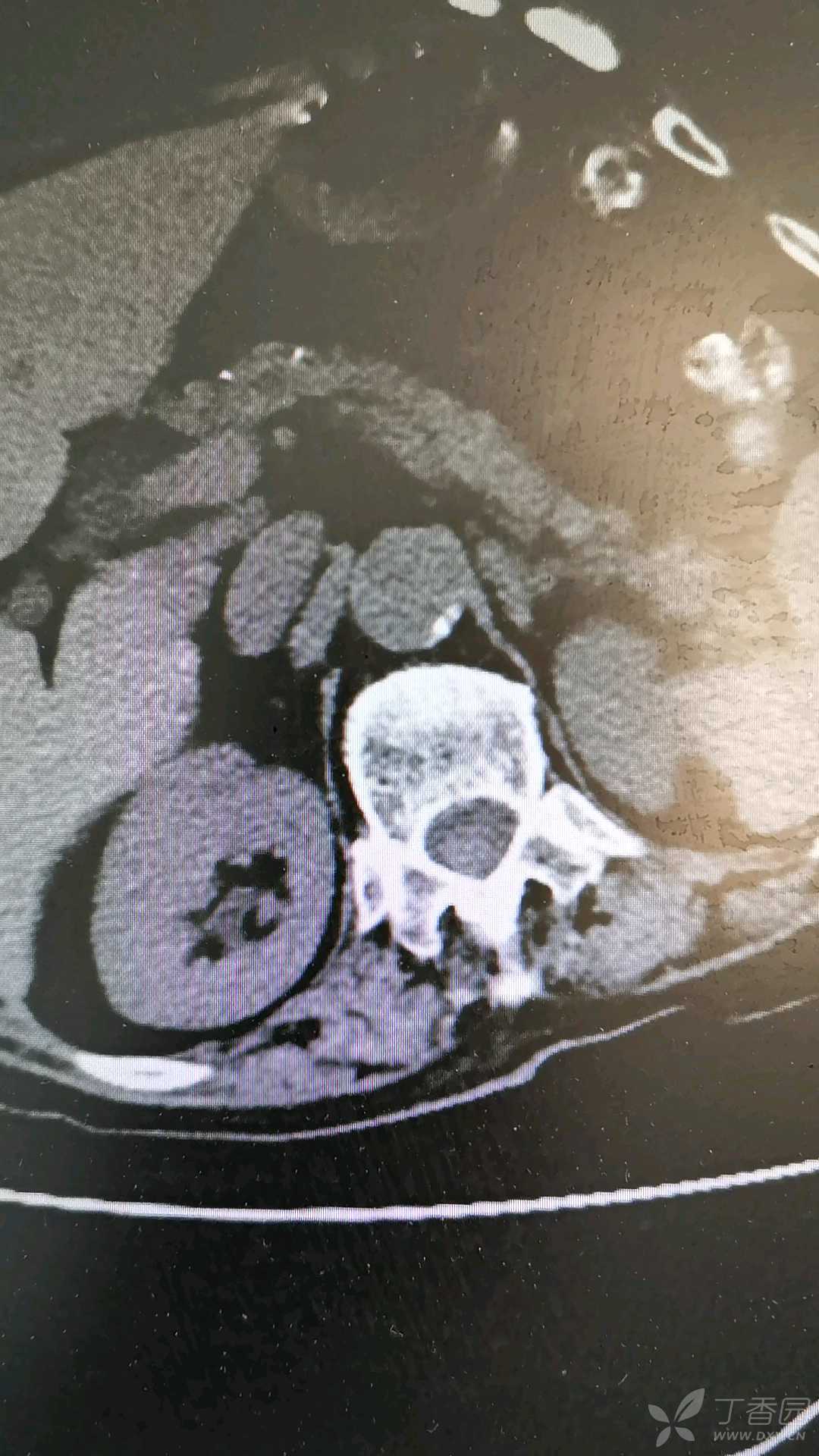 双输尿管结石严重吗 3383753597237464708-16w.jpg
