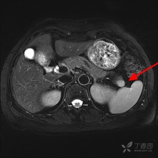 證實為胰尾部異位脾臟 副脾是位於正常脾臟之外的與正常脾臟結構相似