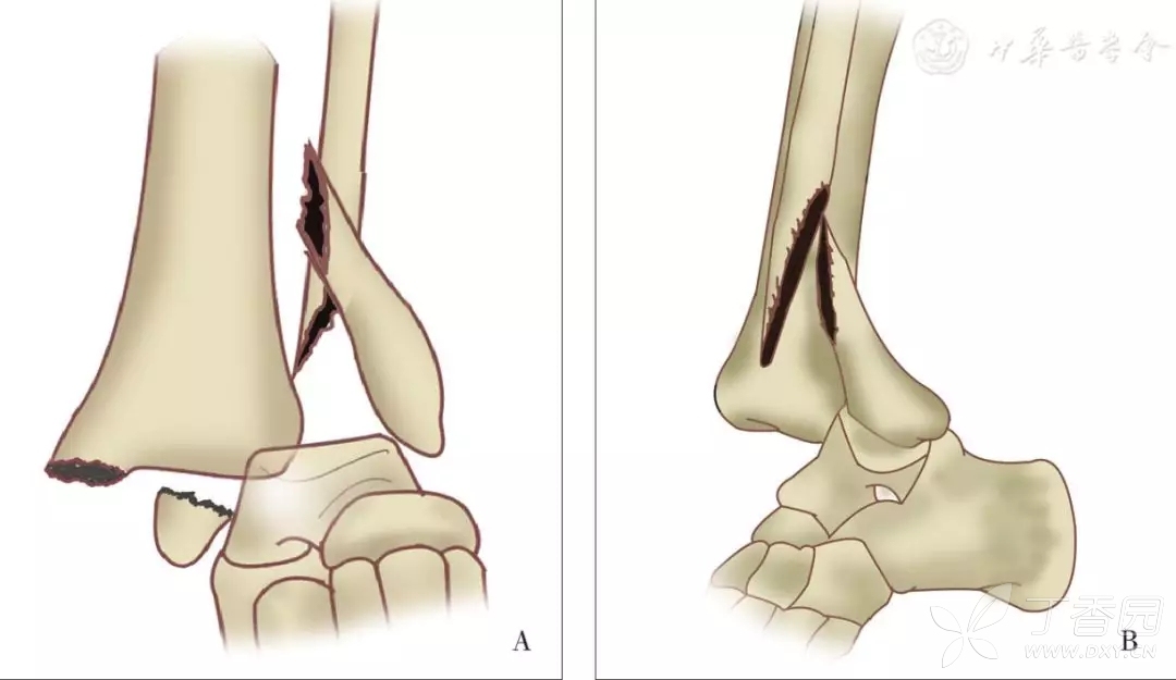 综述 特殊命名的踝关节骨折及其诊疗要点 转 骨科 丁香园论坛
