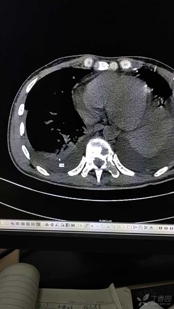 黑色素瘤多发脏器转移骨转移