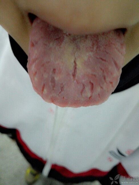 看图识病40:看这个舌头裂纹,你知道什么病因吗?