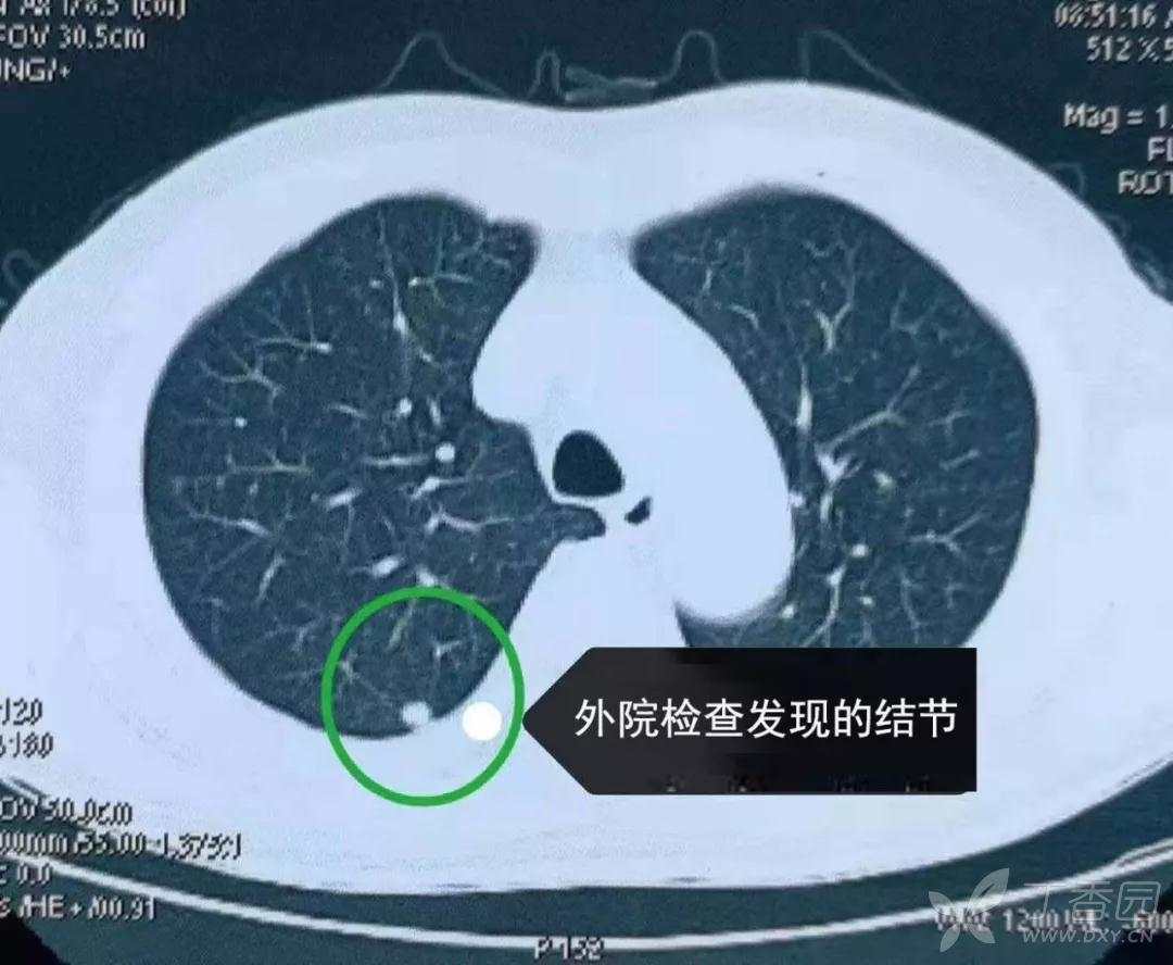 小结节随访未变化,右肺下叶出现新发病灶 - 丁香园论坛