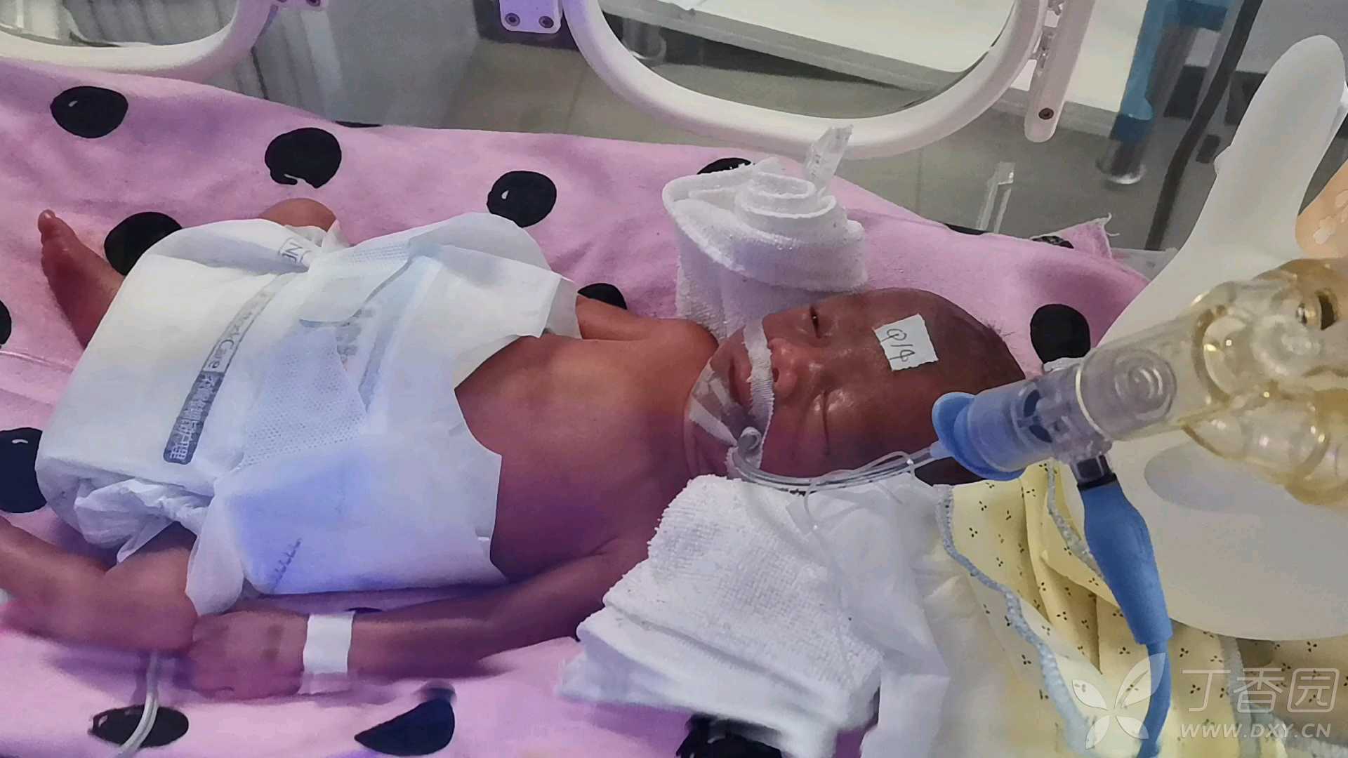 新生儿基础—呼吸三凹征