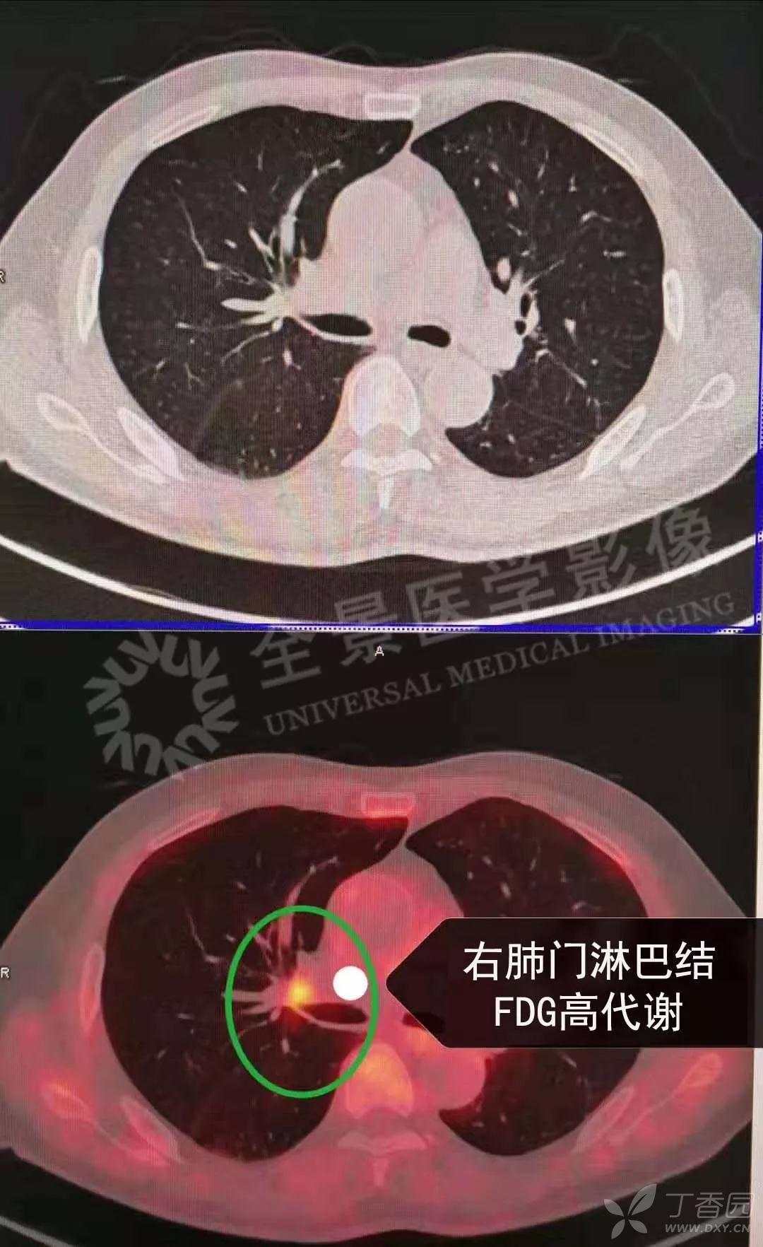 小结节随访未变化,右肺下叶出现新发病灶
