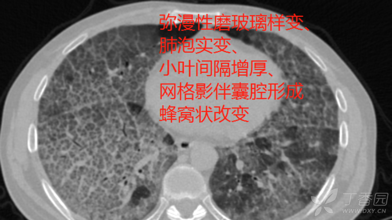 二期尘肺图片图片