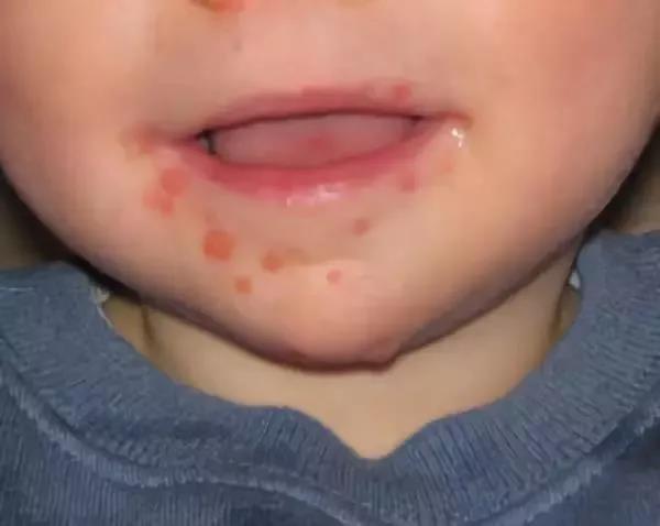 婴儿水泡型疱疹图片图片