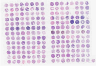 多器官肿瘤组合芯片X2080001