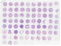肺癌及匹配或不匹配的瘤旁肺组织组合芯片R731001