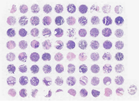 卵巢上皮来源肿瘤及瘤旁卵巢组织组合芯片 F801401