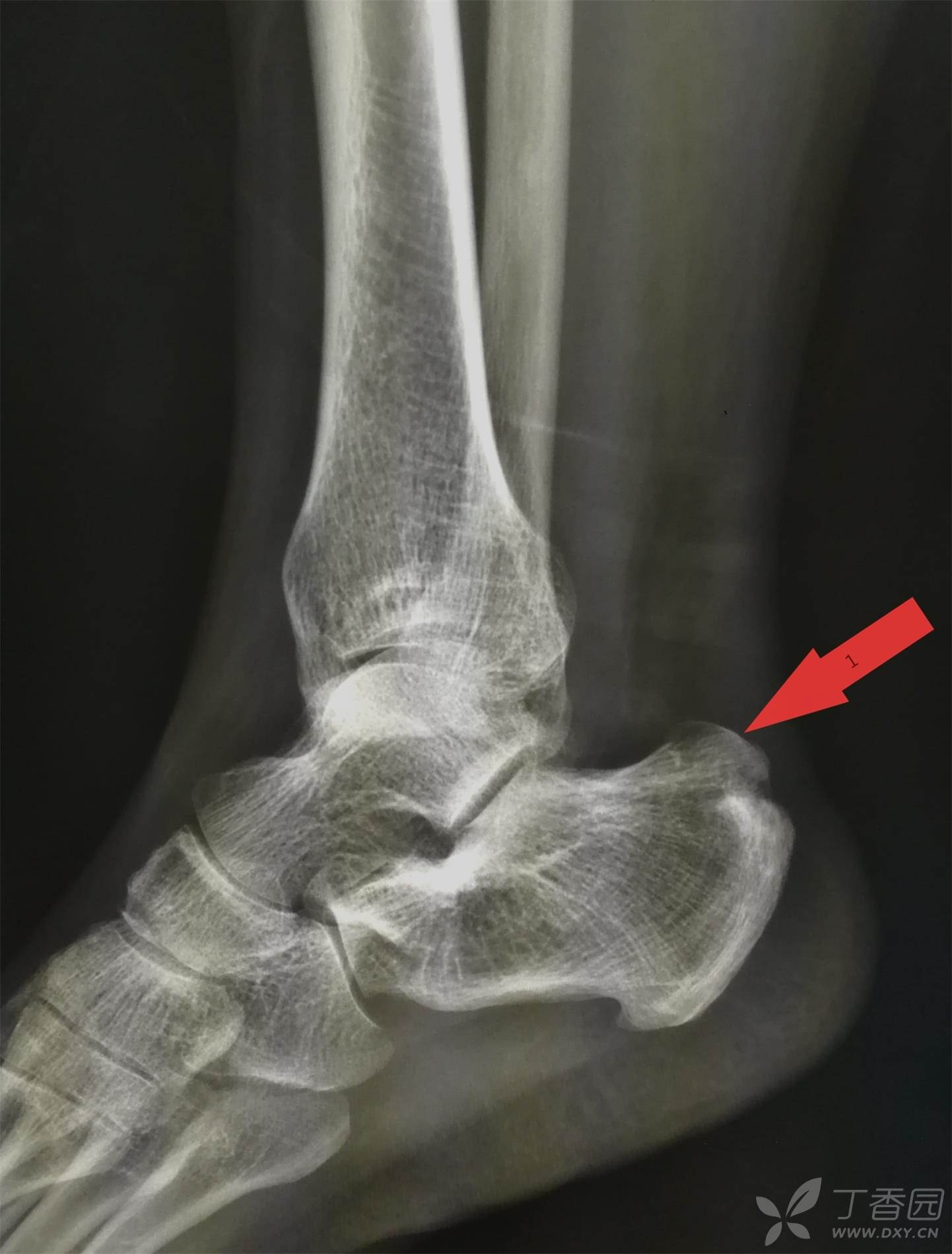 请教一下,这跟骨后上缘突起正常吗?