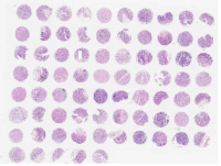 胃癌及匹配瘤旁胃组织芯片 D750201