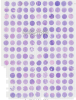 乳腺癌组织芯片F1601101