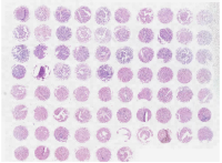 肝癌及匹配或不匹配的瘤旁肝组织组合芯片D760601