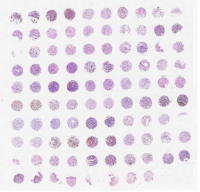 黑色素瘤原发+转移+正常组合芯片K983501