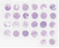 神经母细胞瘤及正常肾上腺组织芯片，附INSS分期N264001