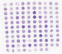 宫颈癌及瘤旁宫颈组织组合芯片F1081301
