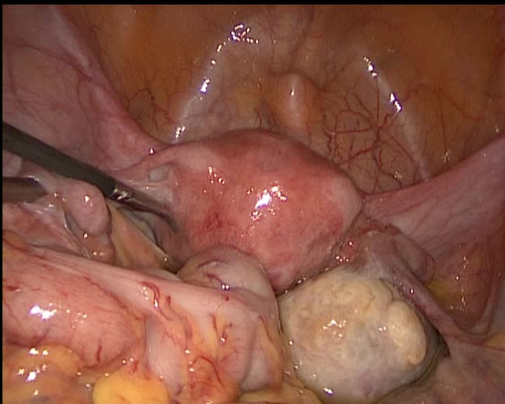 卵巢囊肿打孔手术图片图片