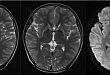 MRI 双侧纹状体异常的 6 种疾病，你都知道吗？