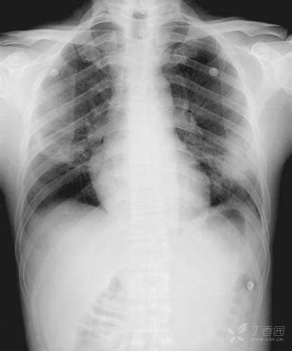 勇哥肺炎研习社|诊断篇: 16年前香港sars大爆发