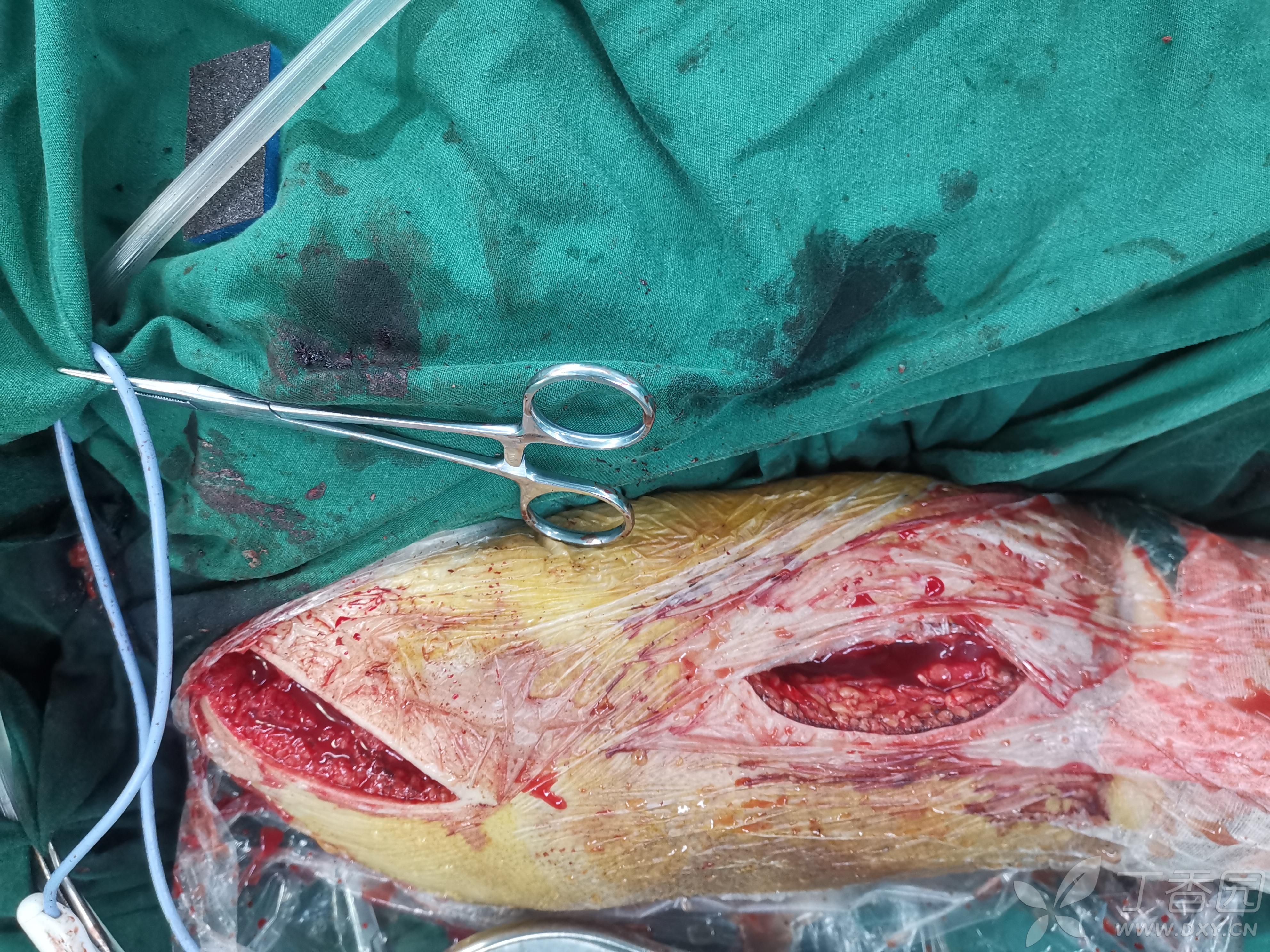 黄骨头肱骨骨折——2019年两台收官multiloc髓内针固定 [病例帖]