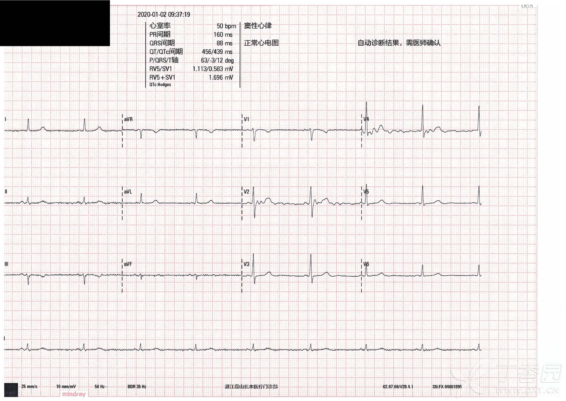 正常心电图v1导联t波图片