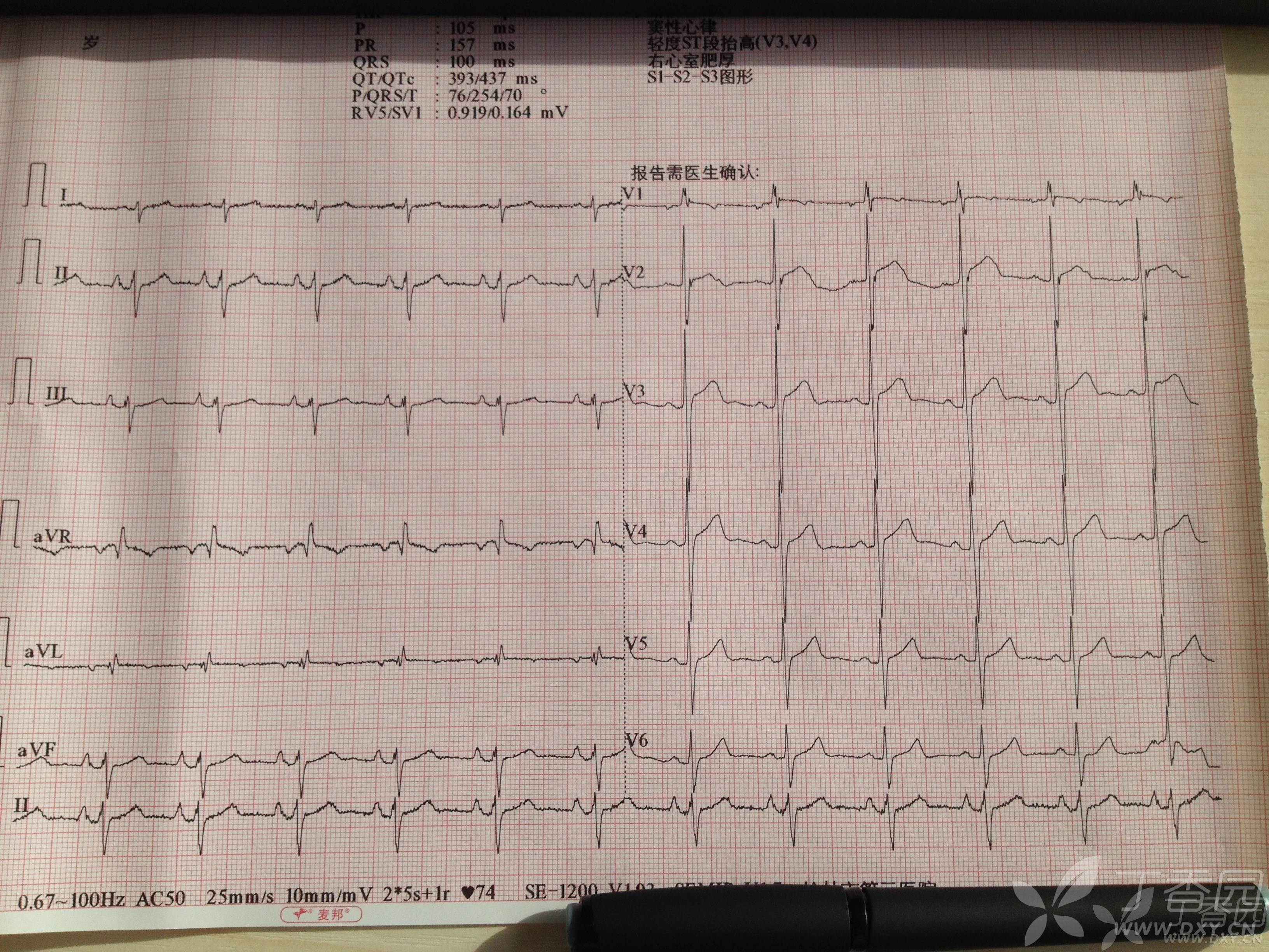 典型心电图,一眼识别-公布于42楼.