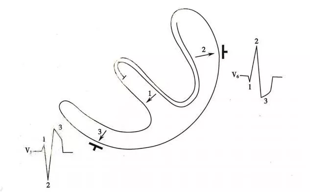 这 4 张心电图，你看的对吗？（附答案）| 心电视频第 7 期