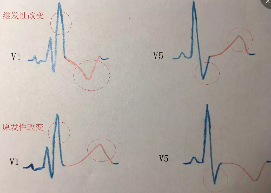 这 4 张心电图，你看的对吗？（附答案）| 心电视频第 7 期