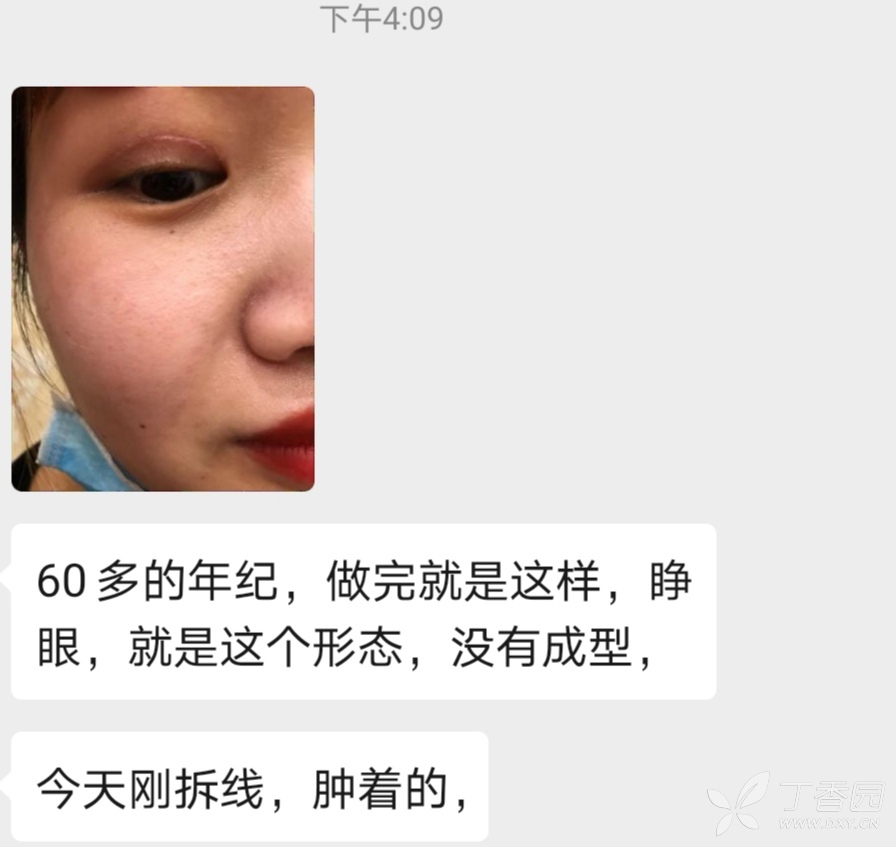 其它 不良重睑产生原因和修复 九院笔记 修复重建和烧伤整形讨论版 丁香园论坛