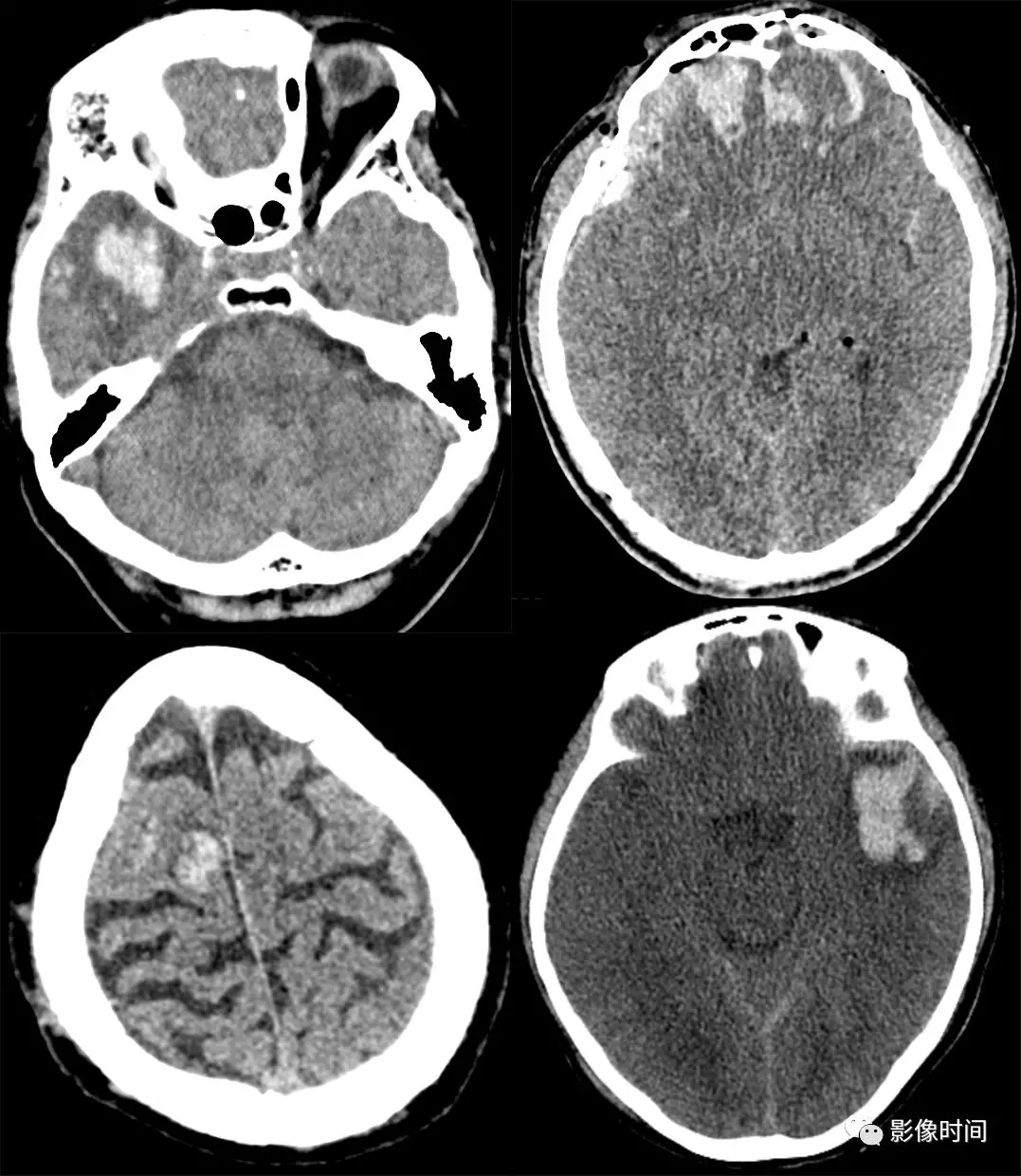 【疾病百科】放射性脑干损伤——早发现早治疗