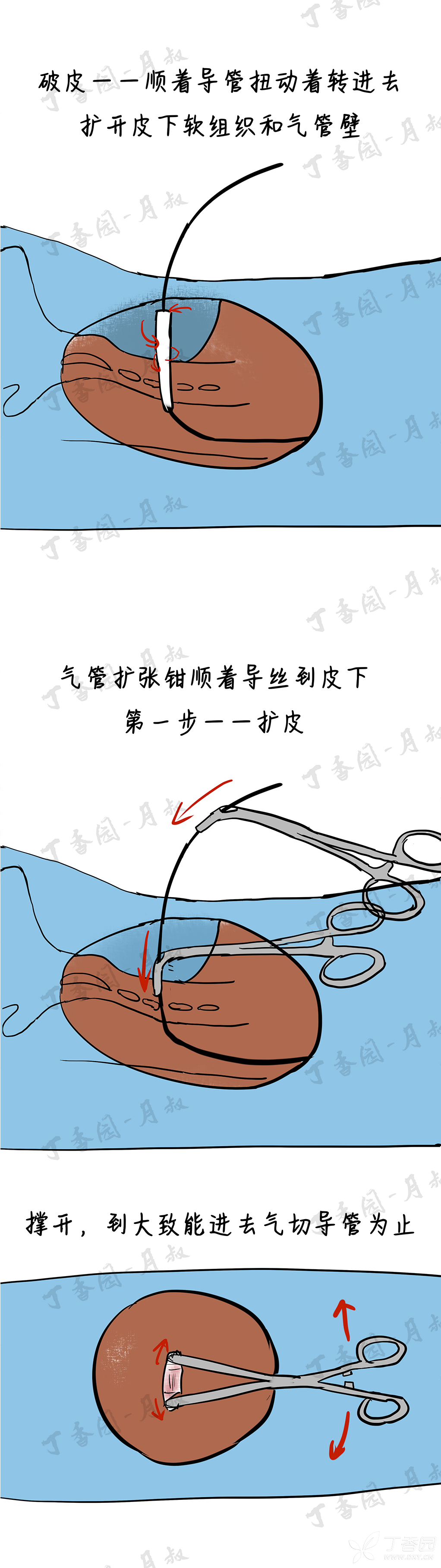 气管切开术步骤图解图片