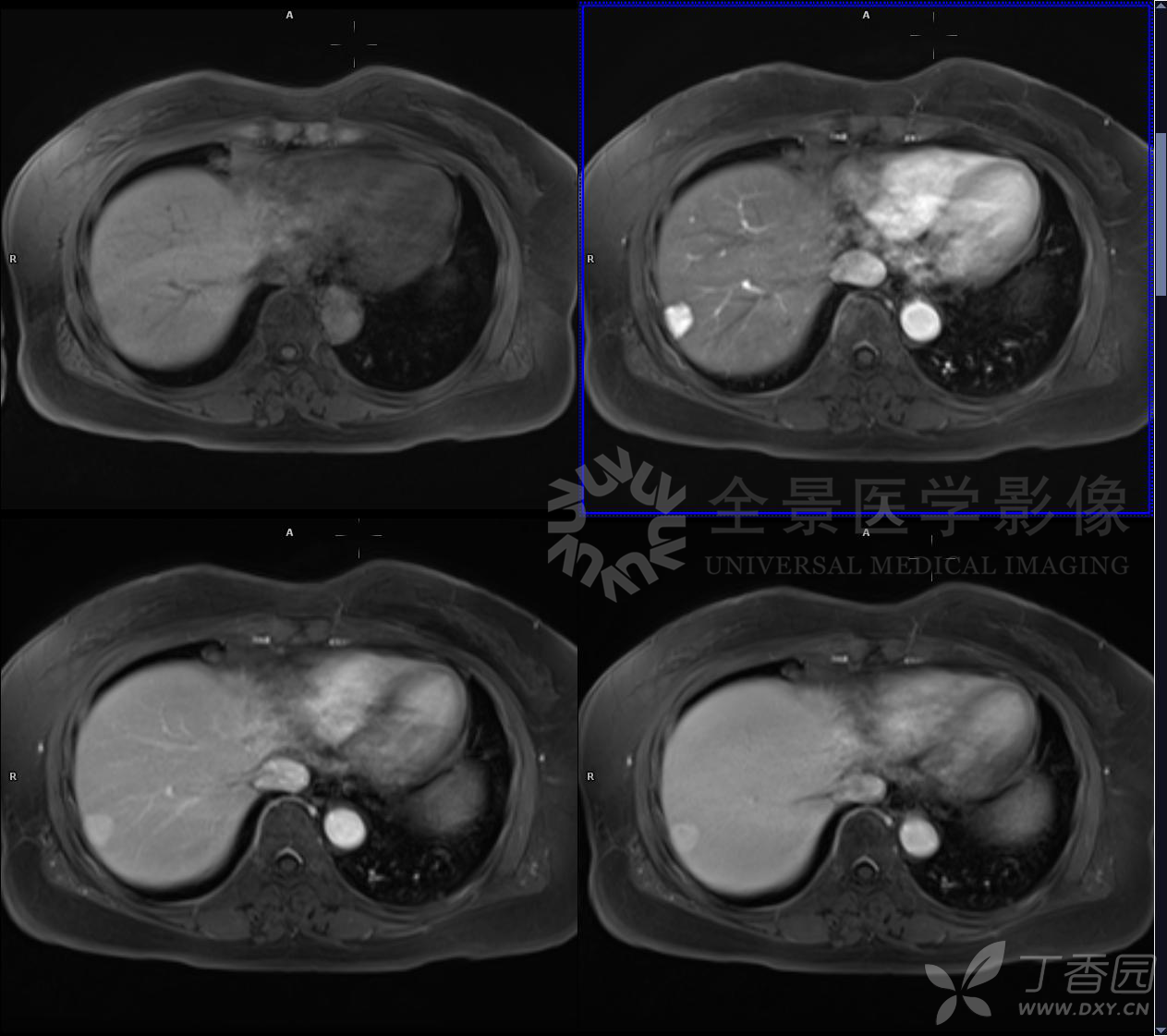 B超显示肝部有低回声团，边界不清，CT检查有低密度影，是肝癌吗？-