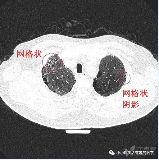 间质性肺炎影像学图片图片