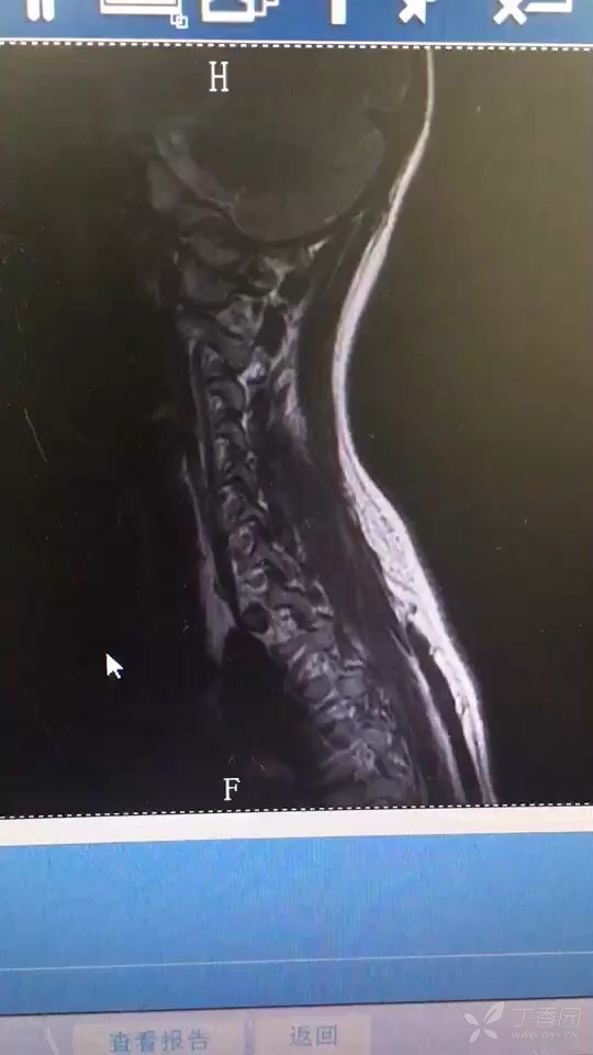 怎样快速识别脊髓or中枢病变 如何诊断 神经科学专业讨论版 丁香园论坛