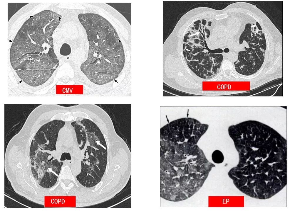 新冠肺炎的肺图片图片