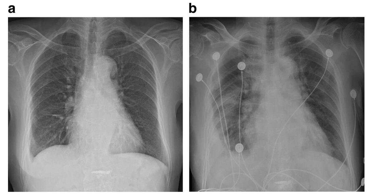 冠状动脉搭桥术或引发甲状腺危象 - 丁香园论坛