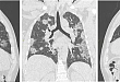 图解：新型冠状病毒肺炎的影像学表现