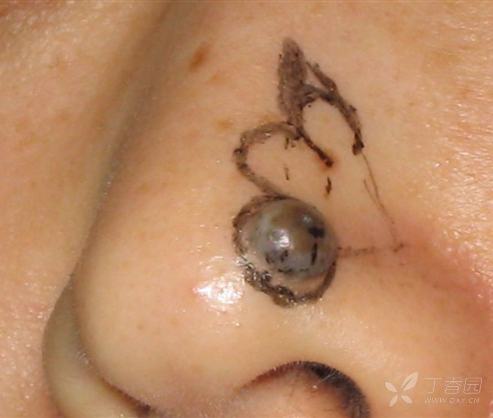 【讨论】鼻尖基底细胞癌扩切,鼻唇沟皮下组织蒂皮瓣修复