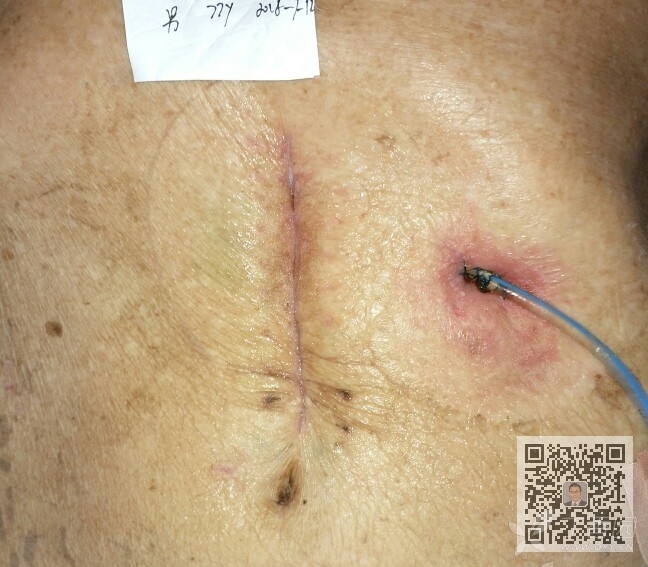 肛瘘术后疤痕图片