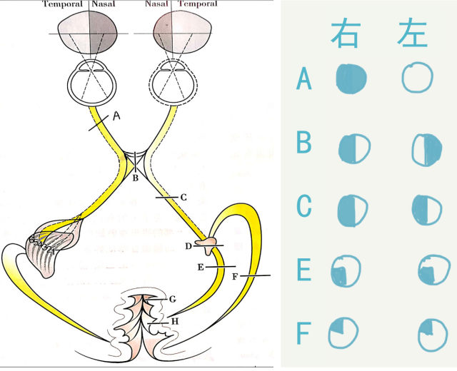 颞侧视野缺损图片